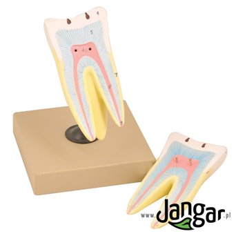 Model of a molar tooth with caries, 10x, 2x.