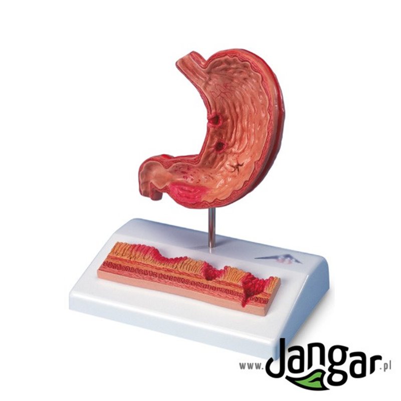 Model żołądka człowieka z owrzodzeniem