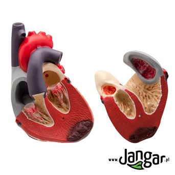 Model of the structure of the human heart and vessels affected by the disease