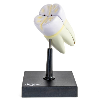Molar tooth model with caries, 10x, 2-part