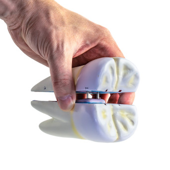Molar tooth model with caries, 10x, 2-part