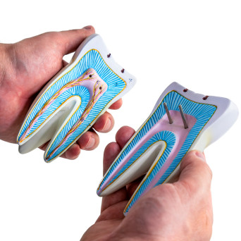 Molar tooth model with caries, 10x, 2-part