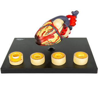 Model of the Human Heart Anatomy and Disease-Affected Blood Vessels