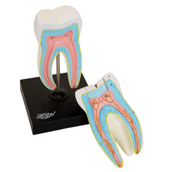 Molar Tooth Model with 3 Stages of Caries, 6-Part, 8x Enlarged